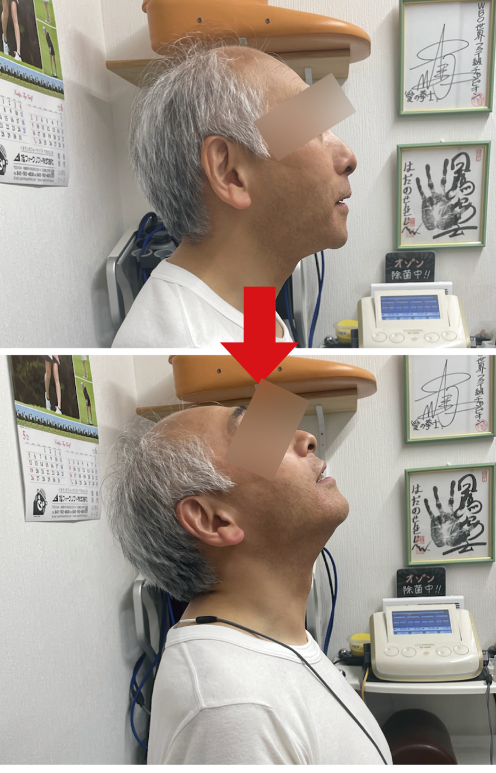 首の角度改善